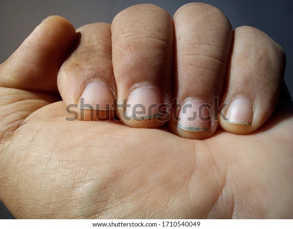 Dirty Fingernail Close Unhygienic Black Fingernails Stock Photo Edit Now