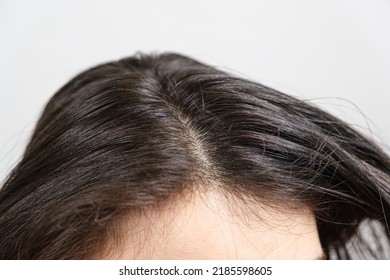 Dirty Greasy Brown Long Hair With Dandruff, Close-up.