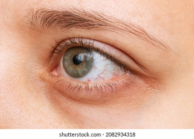 Disease of retina of the eye. Close-up of female eye with red inflamed and dilated capillaries. Hemorrhage under the conjunctiva. Conjunctivitis, keratitis, dry eye syndrome, trauma, uveitis