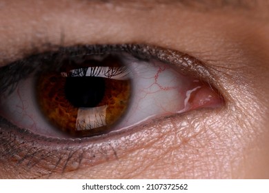 Disease Of Retina Of The Eye. Close-up Of Female Eye With Red Inflamed And Dilated Capillaries.