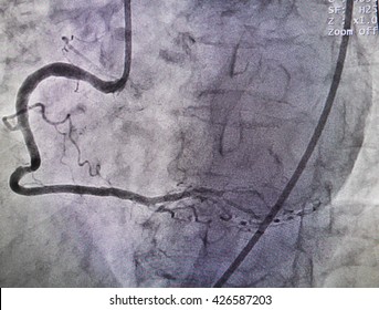 Disease At Right Coronary Artery From X-ray In Cardiac Catheterization Laboratory