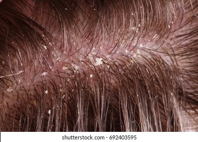 Dirty Scalp Images, Stock Photos & Vectors | Shutterstock