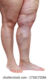 The Disease Varicose Veins On A Legs