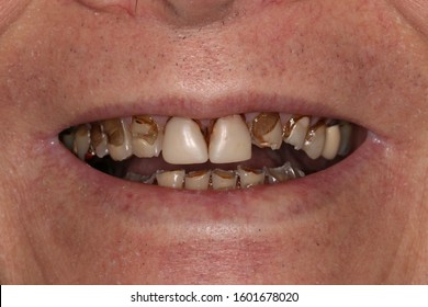 Bad Teeth Images, Stock Photos & Vectors | Shutterstock