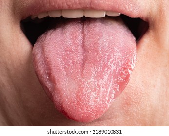 Diseases Of The Oral Cavity, Tongue Infections Cancer.