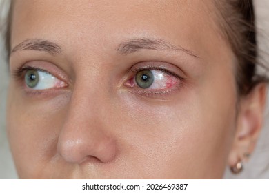 Diseases of the retina of the eye. Close-up of female eyes with red inflamed and dilated capillaries. Hemorrhage under the conjunctiva. Conjunctivitis, keratitis, dry eye syndrome, trauma, uveitis