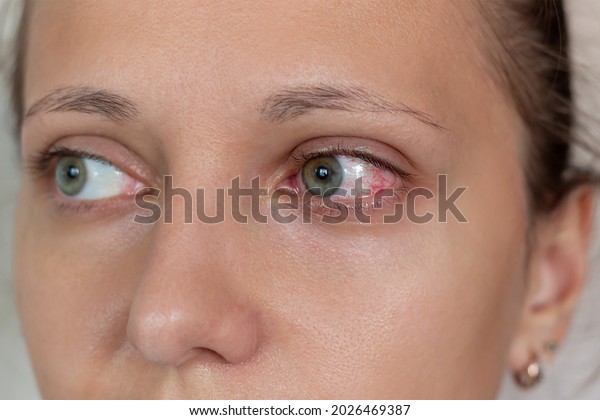 Diseases of the retina of the eye. Close-up of\
female eyes with red inflamed and dilated capillaries. Hemorrhage\
under the conjunctiva. Conjunctivitis, keratitis, dry eye syndrome,\
trauma, uveitis