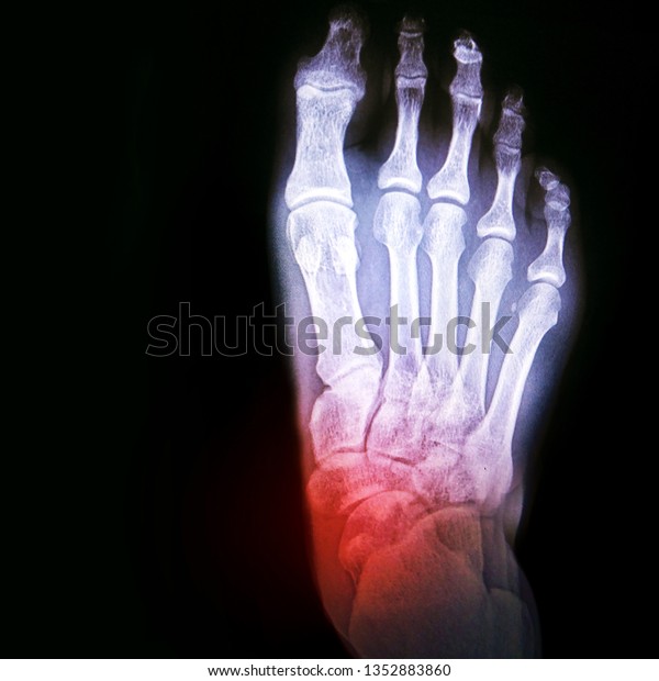 Dislocation Ankle Arthritis Joint Xray Foot Stock Photo