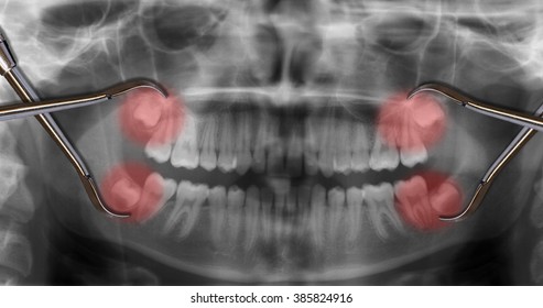 Display Four Wisdom Teeth Over X-ray