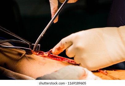 Dissection Graft For Coronary Bypass Graft