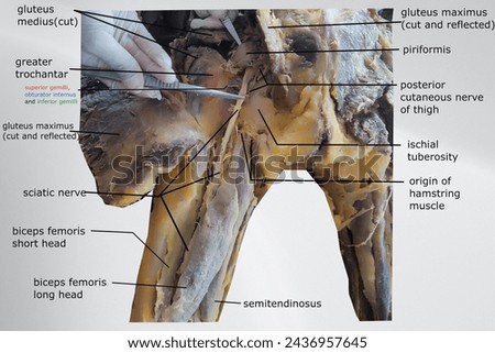 dissection pic of gluteal region with sciatic nerve course