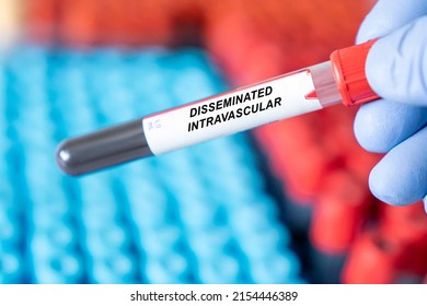 Disseminated Intravascular Coagulation. Disseminated Intravascular Coagulation Disease Blood Test Inmedical Laboratory