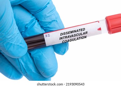 Disseminated Intravascular Coagulation. Disseminated Intravascular Coagulation Disease Blood Test In Doctor Hand