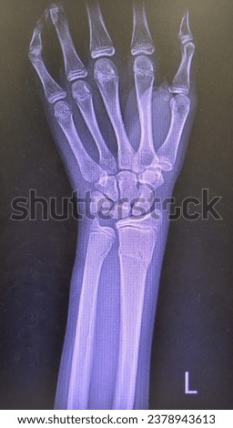 Distal end radius and ulna bone fracture