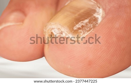 Distal subungual onychomycosis Fungal Nail Infection. Onychomycosis or tinea unguium. Four classic types of 
onychomycosis,Distal lateral subungual onychomycosis of the finger