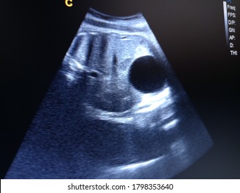 Distended Bladder In Fetus By Ultrasound