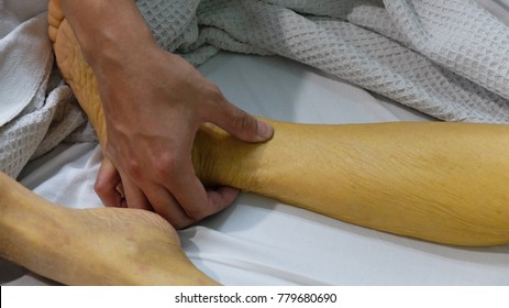 Docto Pressing The Jaundice Patient Leg To Check For Oedema. Sign Of Liver Failure. 