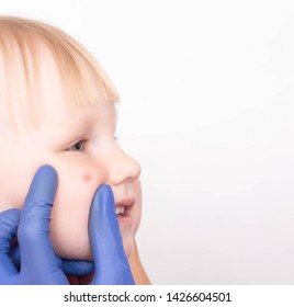 Doctor Allergist Examines A Red Pimple On The Face Of A Little Girl's Child For The Presence Of An Allergy To Sweets, Copy Space, Dermatitis