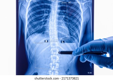 Médico analizando rayos X de la columna vertebral mostrando escoliosis en el área lumbar. La escoliosis es una curvatura lateral anormal de la columna vertebral.