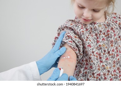 Doctor Applaying Ointment Onto Red And Itchy Eczema On Kid's Arm. Toddler Girl Suffering From Atopic Dermatitis, Close Up Image.
