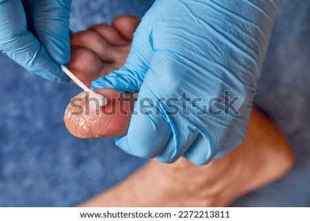 The doctor applies a healing ointment to the damaged skin of the toe.
