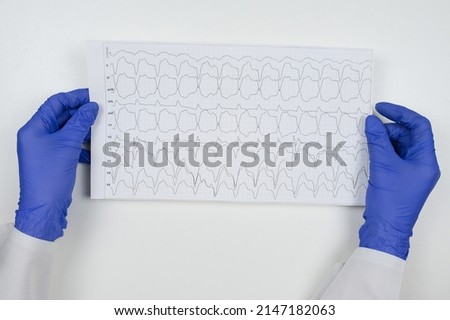 A doctor in blue gloves holds in his hands an ECG with rhythm disturbance - atrial flutter. High quality photo