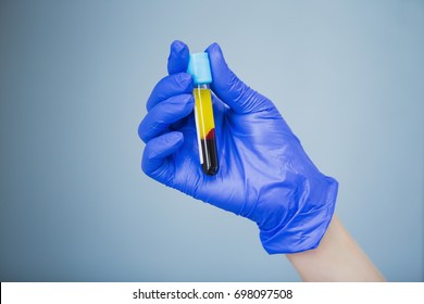 Doctor In Blue Gloves Keep In Hands Test Tube With A Blood And Plasma. Syringe With Platelet Rich Plasma. Beauty Injection 