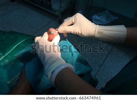 The doctor cleaning wound and cutting gangrene at big toe
