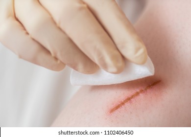 A Doctor Cleans A Wound With An Alcohol Swab. Close Up