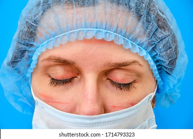 Doctor With Closed Eyes And Facial Wounds From A Medical Mask, Close-up. Nurse On A Blue Background With Red Marks From A Protective Mask, Lifestyle.