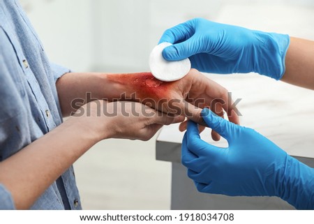 Doctor covering patient's burn of hand with cotton pad indoors, closeup
