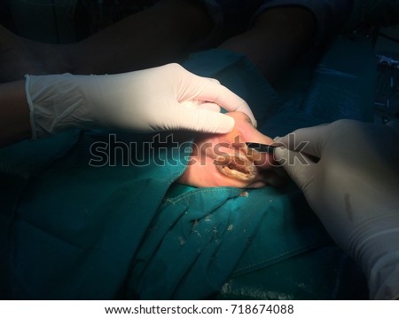 The doctor cut the callus or gangrene wound patient at foot patient with blade in operation room/light focus on the wound