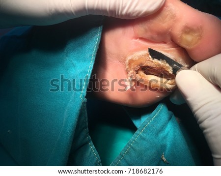 The doctor cut the gangrene or the callus with at foot patient with the blade in operation room/light focus on the wound