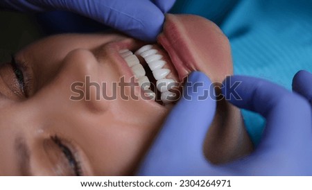 Doctor dentist examining teeth with veneers of female patient in clinic closeup