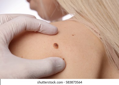 Doctor dermatologist examines birthmark of patient close up isolated on white background. Checking benign moles. Laser Skin tags removal