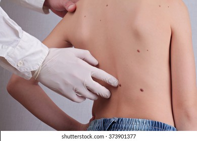 Doctor Dermatologist Examines  Child Patient Birthmark Close Up. Mole Checkup. Skin Tags Removal