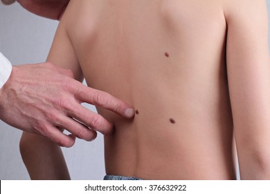 Doctor Dermatologist Examines Child Patient Birthmark Close Up. Mole Checkup.Skin Tags Removal