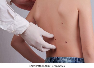 Doctor Dermatologist Examines Child Patient Birthmark Close Up. Mole Checkup.Skin Tags Removal. Sun Exposure Effect On Skin, Health Effects Of UV Radiation