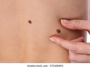 Doctor Dermatologist Examines Child Patient Birthmark Close Up. Mole Checkup.Skin Tags Removal