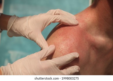 Doctor Dermatologist Examining Rash On Skin Of Man Shoulders Using Gloves Closeup