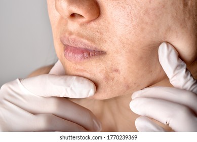 Doctor Or Dermatologist Hand Exam Patient Face. Skin Problems And Acne Scar, Acne Facial Care Treatment, Health And Beauty Concept.