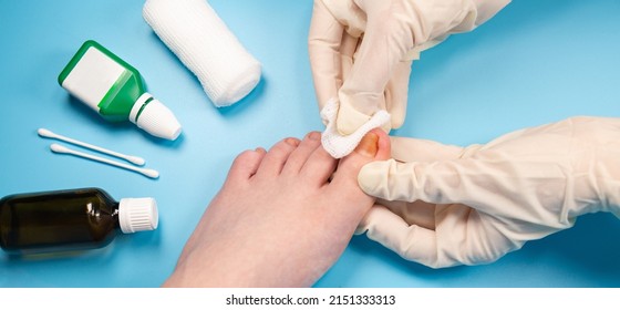 doctor disinfect the injured toenail. Hands in rubber gloves touch injured toenail in clinic. Diagnosis, treatment of mycosis of feet. Podiatrist treating ingrown toenail. Inflammation of the toes - Shutterstock ID 2151333313