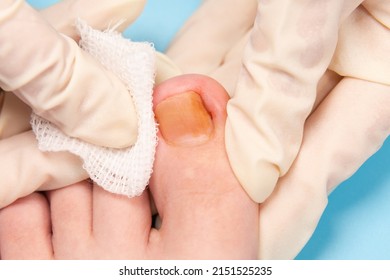 doctor disinfect the injured toenail. Hands in rubber gloves touch injured toenail in clinic. Diagnosis, treatment of mycosis of feet. Podiatrist treating ingrown toenail. Inflammation of the toes - Shutterstock ID 2151525235
