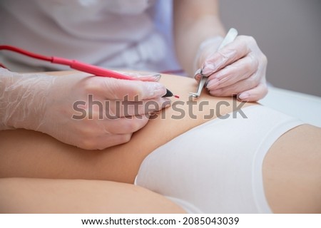 The doctor does electro epilation of the bikini zone to a woman in the salon. An alternative way to permanently remove unwanted body hair