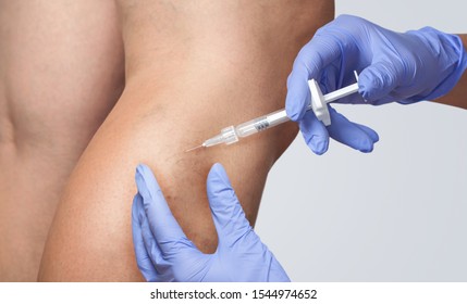 A Doctor Does Medical Procedure Sclerotherapy Used To Eliminate Varicose Veins And Spider Veins. An Injection Of A Solution Directly Into The Vein.