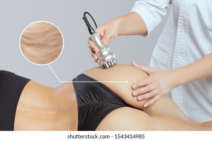 The doctor does the Rf lifting procedure on the legs, buttocks and hips of a woman in a beauty parlor. Treatment of overweight and flabby skin.Cosmetology and professional skin care.