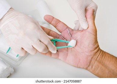Doctor doing wound dressing care, Hand surgery treatment, Trigger finger stiffness painful, Doctor treat patient's hand injury in hospital, Wound stitches at index and middle finger.
