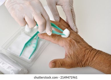 Doctor Doing Wound Dressing Care, Hand Surgery Treatment, Trigger Finger Stiffness Painful, Doctor Treat Patient's Hand Injury In Hospital, Wound Stitches At Index And Middle Finger.