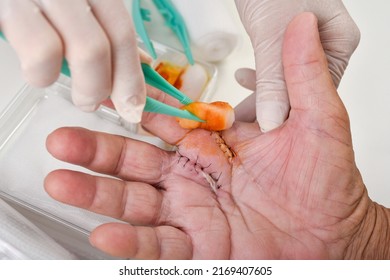 Doctor Doing Wound Dressing Care, Hand Surgery Treatment, Trigger Finger Stiffness Painful, Doctor Treat Patient's Hand Injury In Hospital, Wound Stitches At Index And Middle Finger.