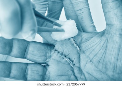 Doctor Doing Wound Dressing Care, Hand Surgery Treatment, Trigger Finger Stiffness Painful, Doctor Treat Patient's Hand Injury In Hospital, Wound Stitches At Index And Middle Finger.